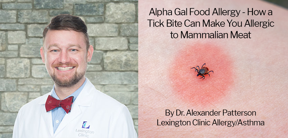 Alpha Gal Food Allergy – How a Tick Bite Can Make You Allergic to Mammalian Meat